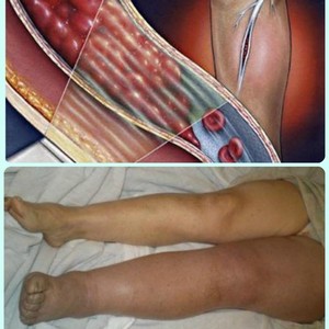 Отзывы пациетов об операциях лазером при варикозе