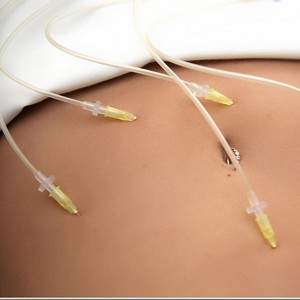 Что такое озонотерапия и помогает ли она похудеть