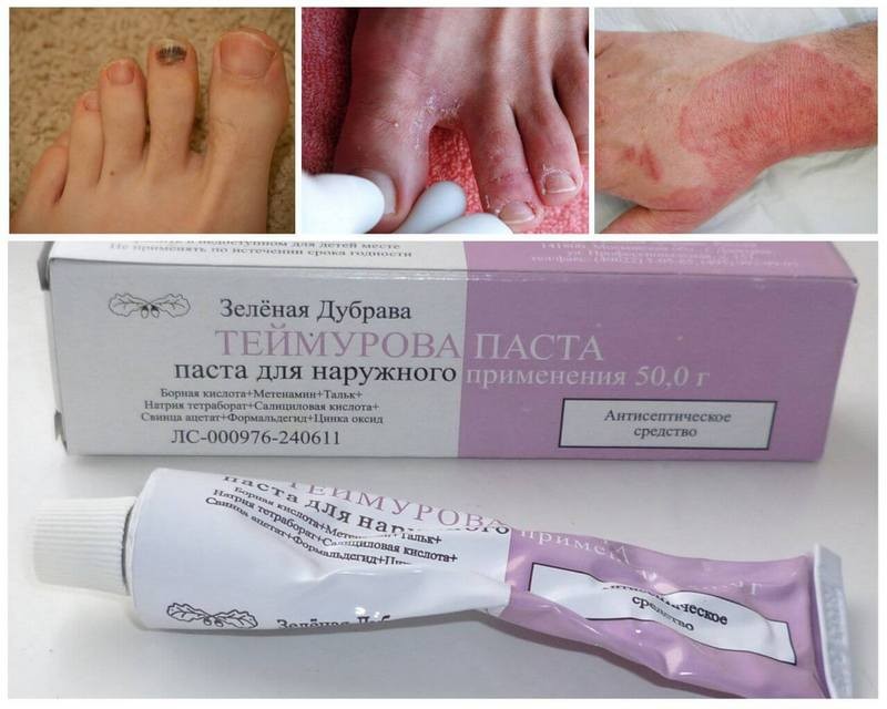 Как применять Пасту Теймурова от грибка ногтей