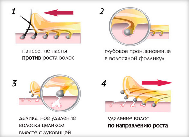 Почему после шугаринга остаются пеньки и как от них избавиться