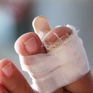 Как лечить перелом большого пальца ноги