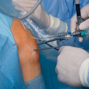 Как лечить перелом коленного сустава