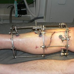 Как лечить перелом берцовой кости