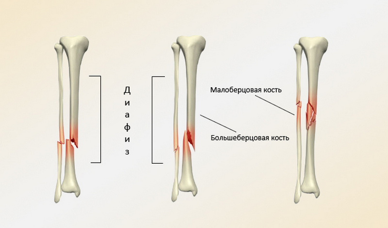 Как лечить перелом берцовой кости