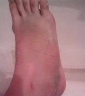 Как проходит реабилитация после перелома плюсневой кости стопы