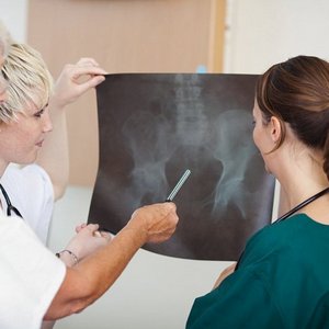 Как лечить перелом седалищной кости