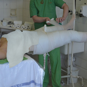 Как лечить перелом седалищной кости