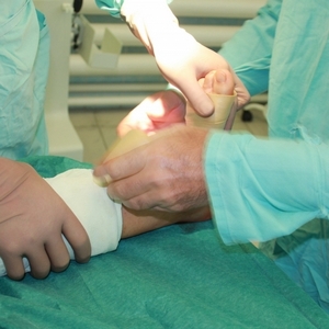 Как лечить перелом стопы