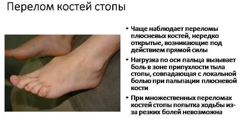 Как лечить перелом стопы