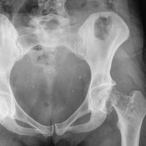 Как лечить перелом тазобедренного сустава