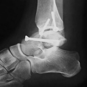 Как лечат перелом таранной кости