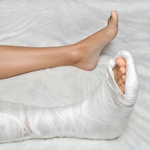 Как лечат перелом таранной кости