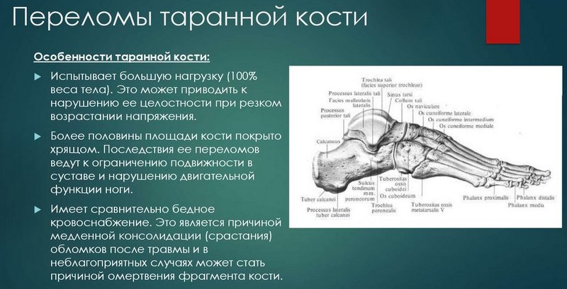 Как лечат перелом таранной кости