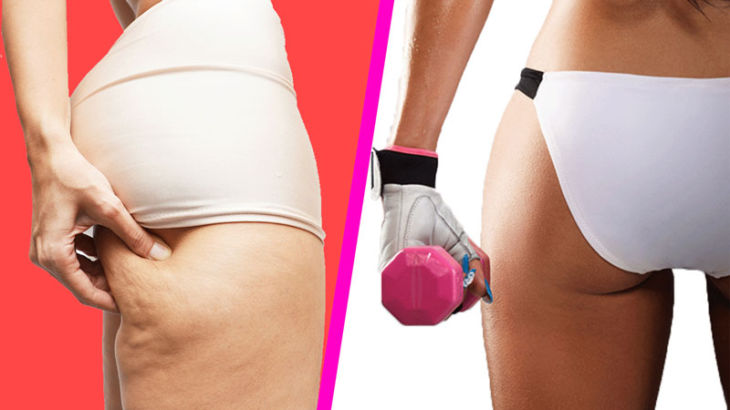 Почему появляется целлюлит у худых, и что с ним делать