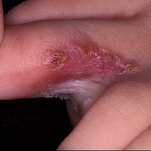 Как лечить трещины между пальцами на ногах и почему кожа трескается