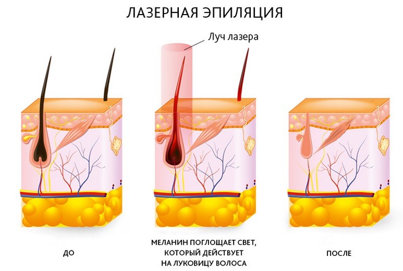 Подготовка к лазерной эпиляции