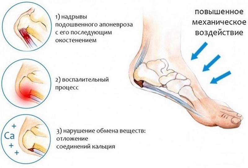 Что такое апоневроз - где он находится и как его лечить если воспалился