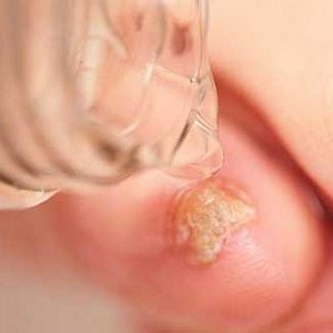 Как применять масло чайного дерева от грибка ногтей