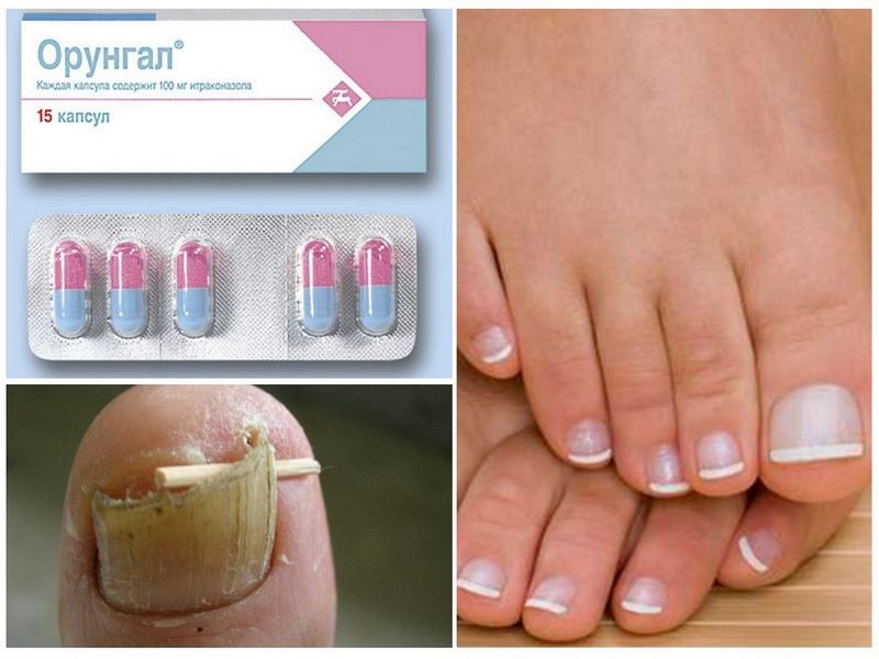 Орунгал: инструкция по применению от грибка ногтей