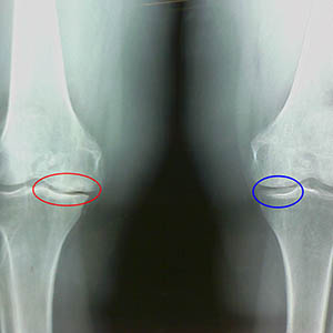 Как лечат артроз коленного сустава