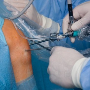 Как лечить артрит коленного сустава