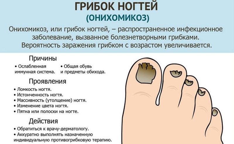 Какие есть способы профилактики грибка ногтей на ногах
