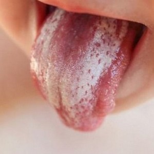 Диета при грибковых заболеваниях: питание при грибке ногтей на ногах