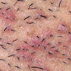 Как убрать раздражение на лобке у мужчин после бритья