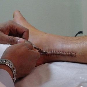 Что делать при разрыве и растяжении ахиллова сухожилия