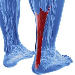 Что делать при разрыве и растяжении ахиллова сухожилия