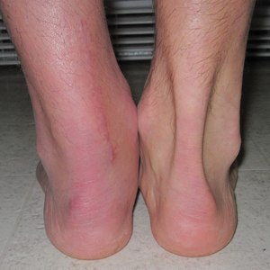 Что делать при разрыве и растяжении ахиллова сухожилия