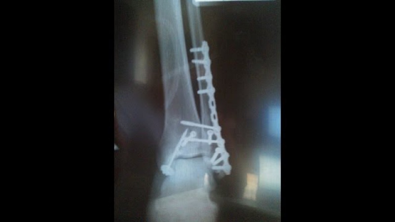 Реабилитация после перелома лодыжки со смещением