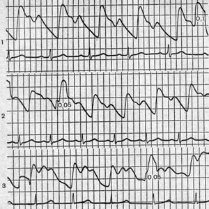 Что такое реовазография нижних конечностей и как она проводится