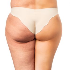 Самый эффективный способ лечения целлюлита