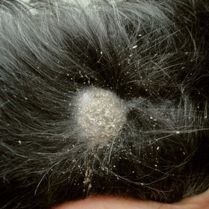 Лечение грибка ногтей серной мазью