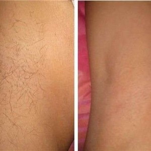 Лазерная эпиляция или шугаринг - вот в чем вопрос