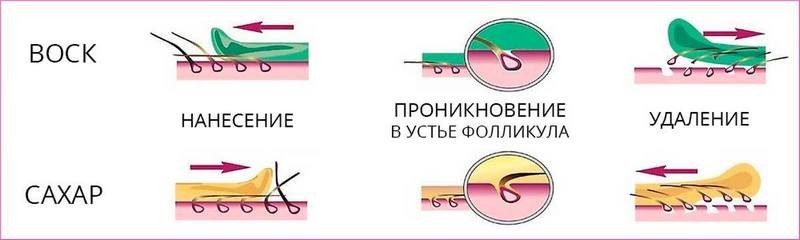 Что лучше - шугаринг или восковая эпиляция