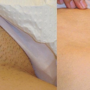 Как делается шугаринг зоны бикини