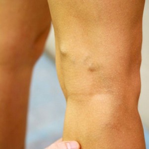 Программа тренировок в тренажерном зале при варикозном расширении вен ног