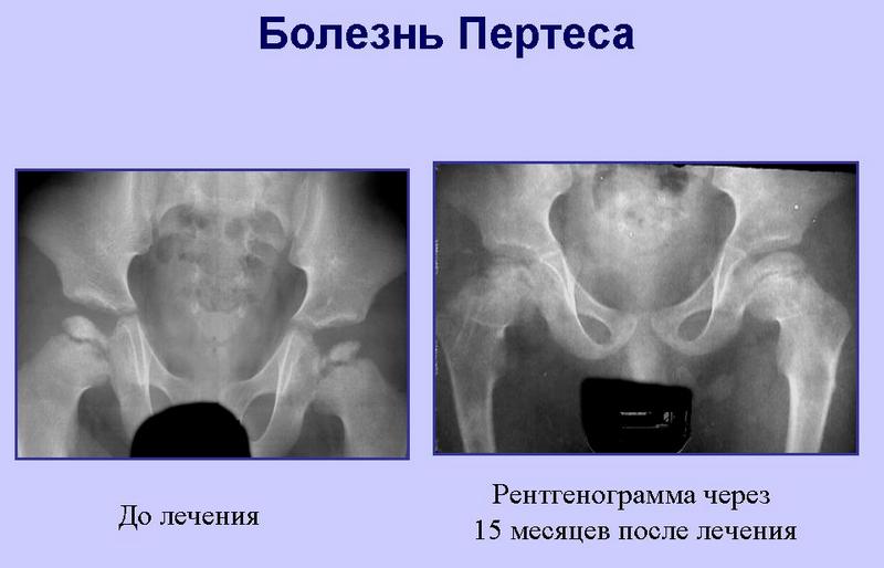 Как лечить болезнь Пертеса тазобедренного сустава