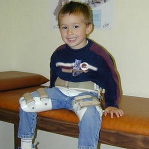 Как лечить болезнь Пертеса тазобедренного сустава