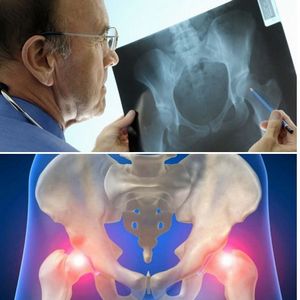 Как лечить болезнь Пертеса тазобедренного сустава