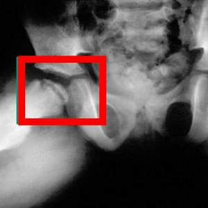 Как лечить болезнь Пертеса тазобедренного сустава