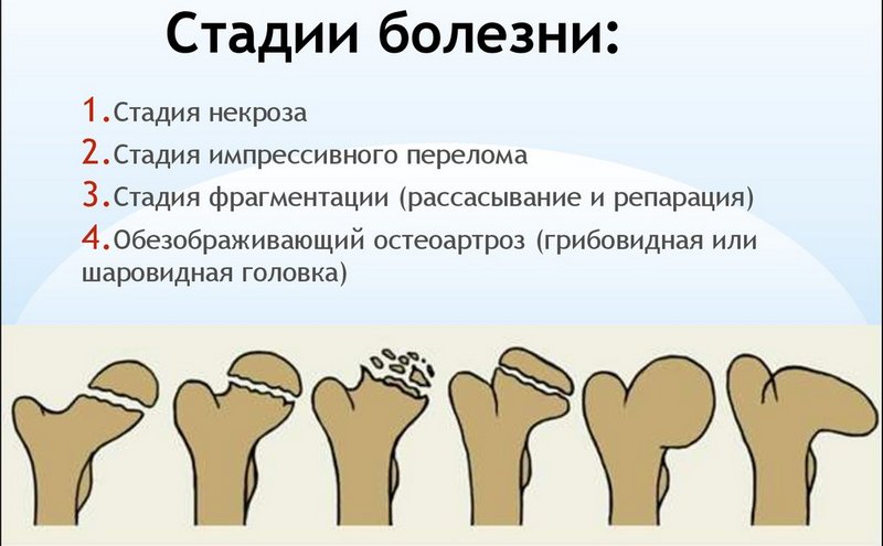 Как лечить болезнь Пертеса тазобедренного сустава