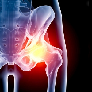 Болезни тазобедренного сустава