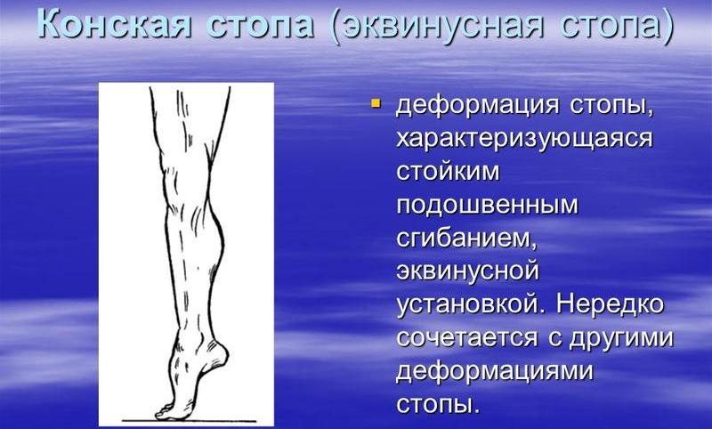 Как лечить эквинусную деформацию стопы
