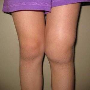 Что такое коксартроз (гонартроз) коленного сустава и как его лечить