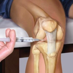 Что такое коксартроз (гонартроз) коленного сустава и как его лечить