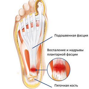 Как лечить плантарный фасциит