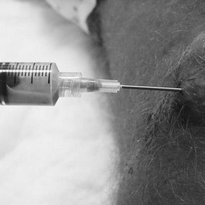 Как лечить препателлярный бурсит коленного сустава